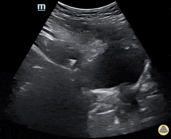 Renal/GU — TPA